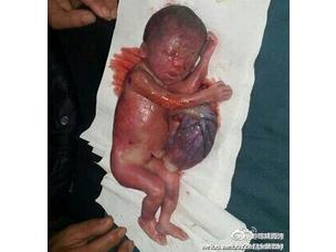 中国民主党计生观察：安徽凤阳7月大胎儿被强制流产 血淋淋图片触目惊心 [转